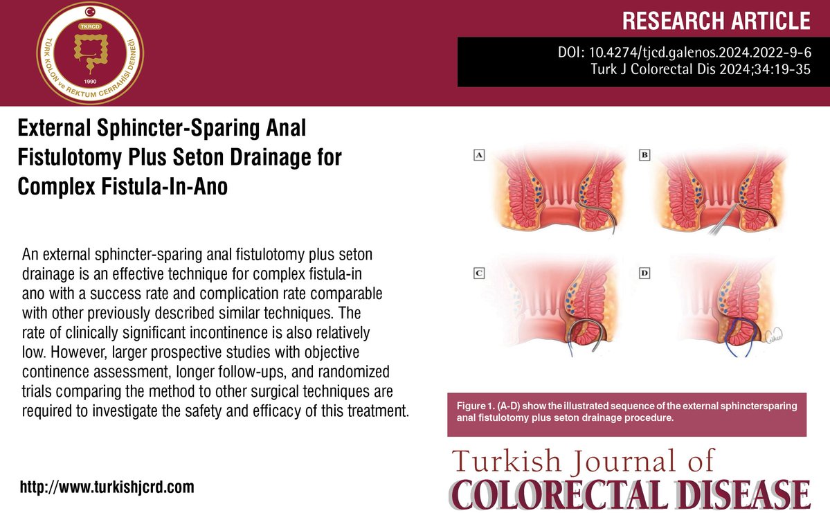 turkdiscolrect's tweet image. External Sphincter-Sparing Anal Fistulotomy Plus Seton Drainage for Complex Fistula-In-Ano
You can see the free full text of the research by Hizami Amin-Tai et al.
Link : turkishjcrd.com/articles/surgi…
#Colorectal #neoplasms #colorectal #surgery #minimally #invasivesurgical #procedures