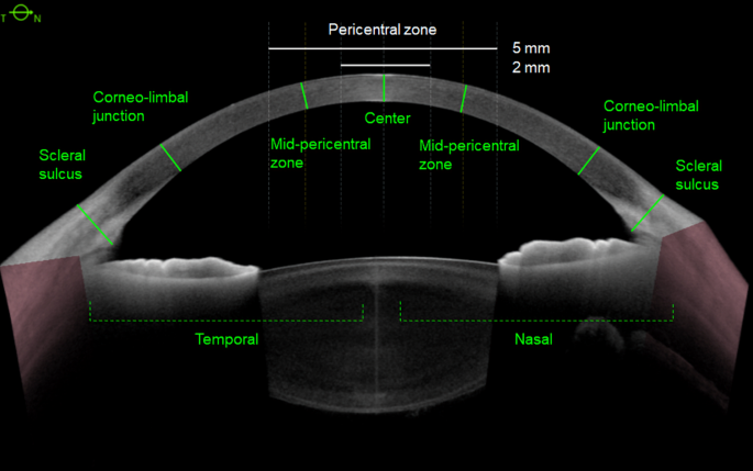 EuCornea (@eucornea) on Twitter photo Corneal enlargement in congenital glaucoma exhibits predominant peripheral corneal thinning, Lee, E.J., Park, D.Y., Kee, C. et al. (OPEN ACCESS) July 2025 via <a href="/SciReports/">Scientific Reports</a>
nature.com/articles/s4159… Corneal enlargement in congenital glaucoma exhibits predominant peripheral corneal thinning, Lee, E.J., Park, D.Y., Kee, C. et al. (OPEN ACCESS) July 2025 via <a href="/SciReports/">Scientific Reports</a>
nature.com/articles/s4159…