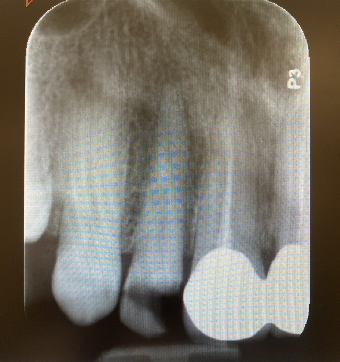Anou2201's tweet photo. Today’s Case: RCT of #12 
With GIC build up ✨ https://t.co/MtS6A76Bc5