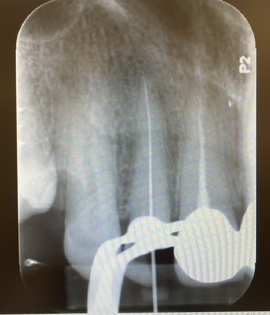 Anou2201's tweet photo. Today’s Case: RCT of #12 
With GIC build up ✨ https://t.co/MtS6A76Bc5