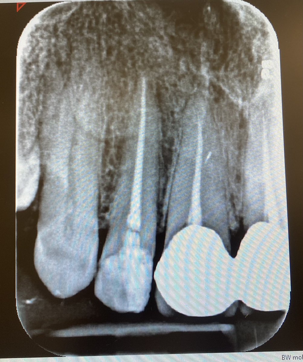 Anou2201's tweet photo. Today’s Case: RCT of #12 
With GIC build up ✨ https://t.co/MtS6A76Bc5