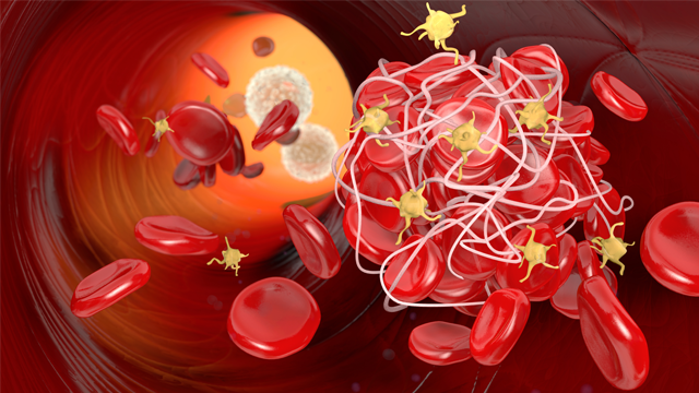 📚 Latest News : "BRIDGE-TNK: Tenecteplase Before Thrombectomy Improves Functional Outcomes in Stroke"

 🔓Access it here 👉 ow.ly/VmJS106fX5t