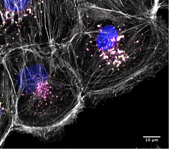 CamBiochem's tweet image. The first patients were enrolled into a clinical trial of alpelisib in Dent disease 2 @bambinogesu, funded by @charitylowe @lowesyndrome and the Dent Disease Foundation. The drug was identified by @GallopLab and Olivier Devuyst&apos;s lab. Read more: bioc.cam.ac.uk/news/first-pil…