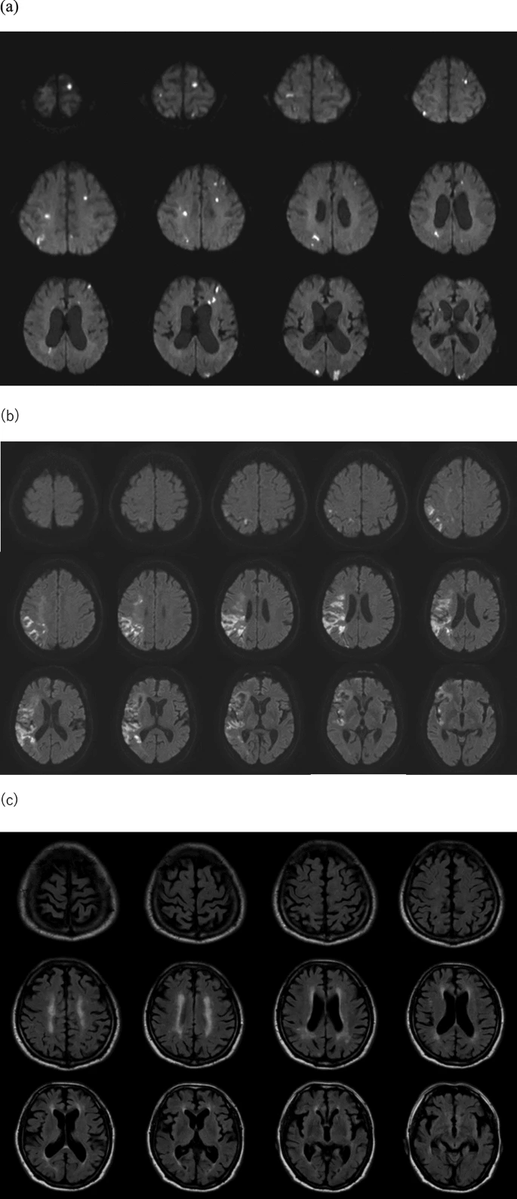 NeurocritCareJ's tweet image. Hosokawa et al: Acute Abnormalities Identified on Brain Magnetic Resonance Imaging in Patients with Sepsis
Link: link.springer.com/article/10.100…
@neurocritical #neurocritcare