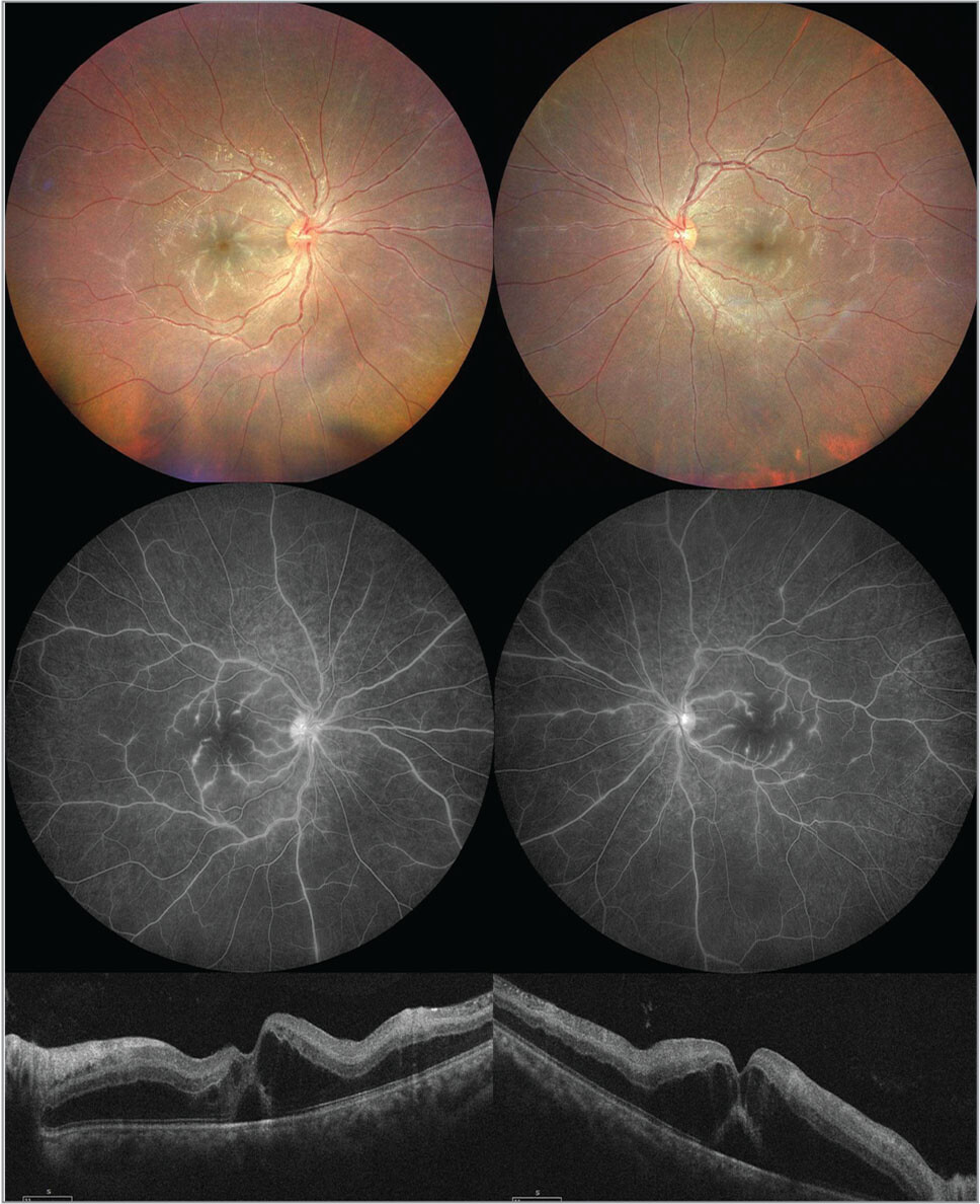 IMAGES in #Ophthalmology: 

Figure 1. Top: Color photography showing bilateral frosted branch. Middle: Fluorescein angiography shows diffuse leakage and staining of the venous vascular tree. 

Read more for FREE: tinyurl.com/acyj45js

 #ophthalmology #retina