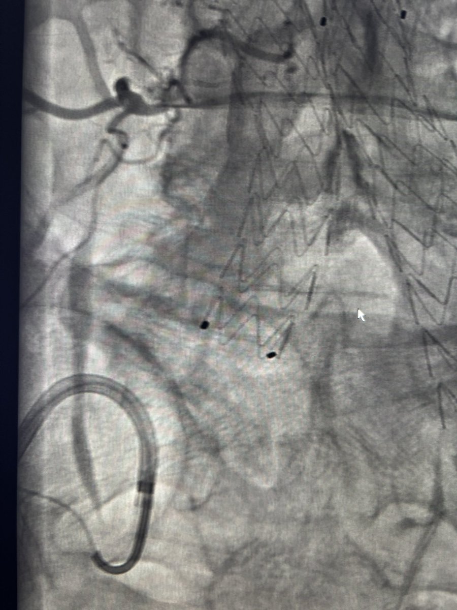 Another type 2. The Sim 2 was not long and stable enough to place the microcath in safe position. Steering sheath finally used in combination of a Rim 5 Fr ( cut tip) and onyx