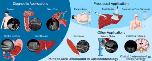DDWMeeting's tweet image. From our July newsletter: A review in @AGA_CGH discusses common #POCUS applications + some novel applications that warrant further investigation. Read the article here: ow.ly/5qs450Wm0lh
#GITwitter