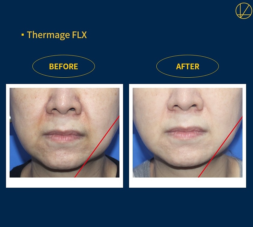 【サーマジFLX キードクター公式認定🏆】 
「同じサーマジでも結果が違う…❗」 
✔ 公式認定医による効果的なリフティング✨
✔ たるみ改善・引き締め
✔ 小ジワやほうれい線に◎

純正チップ＆正規機器使用で安心！
本物の施術は公式認定クリニックで😊❣️

💌ご予約LINE lin.ee/8aSeu34