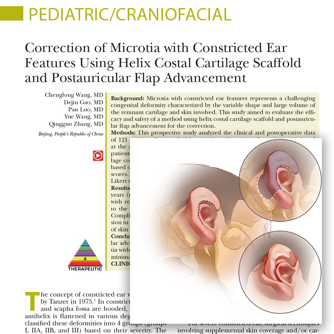 prsjournal's tweet image. New #PRSJournal study shows a reliable way to correct microtia w/ constricted ear features using costal cartilage + postauricular flap advancement. 121 patients, high aesthetic scores, low complications. 👂🔥 Read more: l8r.it/jjTx
#Microtia #Plasticsurgery