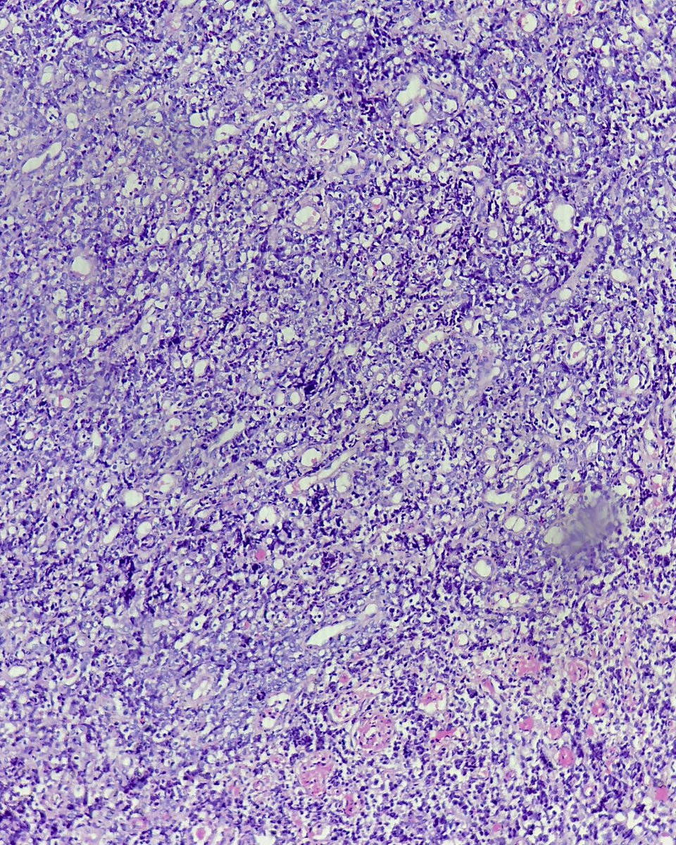 50/post menopausal female, D&amp;C material. 
Mass present in anterior uterine wall.
Presents with bleeding, ascites, skeletal mets in d2-d3 vertebrae.

#Gynpath #Pathology #Pathresidents #PathX #Pathologists #Pathtwitter #Surgpath