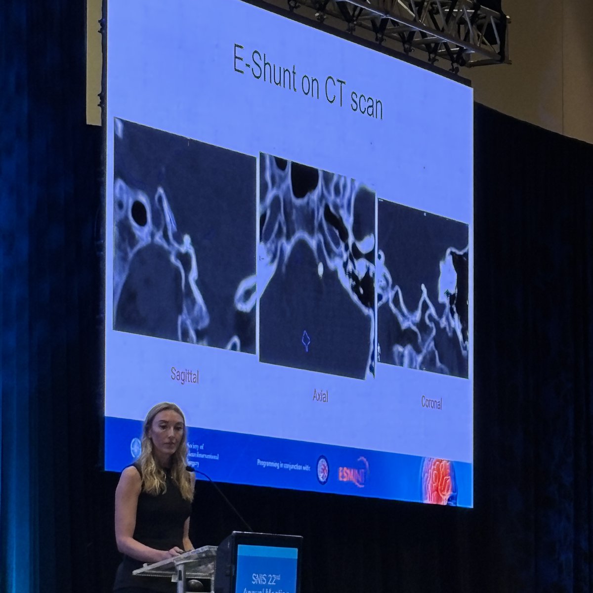 JNIS (@jnis_bmj) on Twitter photo E-shunt time! <a href="/MatoukCharles/">Charles Matouk</a> talking about the treatment of NPH and possible complications. <a href="/amandaebaker/">Amanda Baker, MD</a> discussing the basics of e-shunt placement. The STRIDE trial is enrolling! #SNIS2025 @SNISInfo <a href="/esmintsociety/">ESMINT Society</a> <a href="/cvsection/">CV Section</a> <a href="/fcalbuquerque51/">Felipe C. Albuquerque</a> <a href="/dr_mchen/">Michael Chen, MD</a> <a href="/DanniDiestro/">Dr. DiestroKE</a> <a href="/MattAmansMD/">Matthew Amans</a> E-shunt time! <a href="/MatoukCharles/">Charles Matouk</a> talking about the treatment of NPH and possible complications. <a href="/amandaebaker/">Amanda Baker, MD</a> discussing the basics of e-shunt placement. The STRIDE trial is enrolling! #SNIS2025 @SNISInfo <a href="/esmintsociety/">ESMINT Society</a> <a href="/cvsection/">CV Section</a> <a href="/fcalbuquerque51/">Felipe C. Albuquerque</a> <a href="/dr_mchen/">Michael Chen, MD</a> <a href="/DanniDiestro/">Dr. DiestroKE</a> <a href="/MattAmansMD/">Matthew Amans</a>