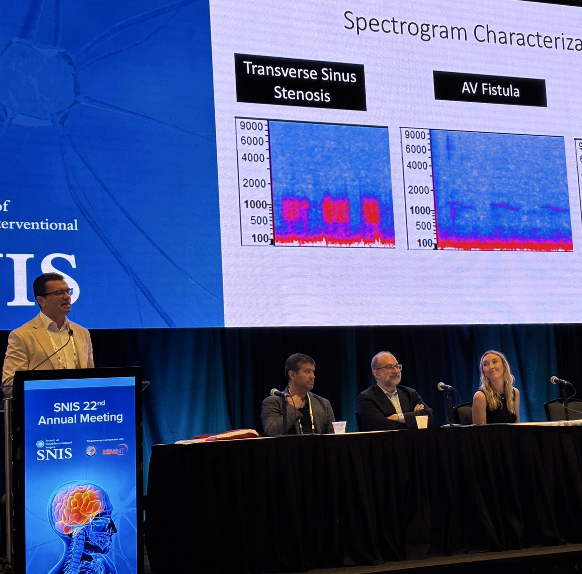 Neurovascular Center @ St. Michael's Hospital (@smhneurovasc) on Twitter photo Division chief <a href="/vitorpereiracan/">Vitor Mendes Pereira</a> talking about one of his favorite topics, pulsatile tinnitus at #SNIS2025 @SNISInfo <a href="/esmintsociety/">ESMINT Society</a> <a href="/cvsection/">CV Section</a> <a href="/fcalbuquerque51/">Felipe C. Albuquerque</a> <a href="/dr_mchen/">Michael Chen, MD</a> <a href="/DanniDiestro/">Dr. DiestroKE</a> <a href="/MattAmansMD/">Matthew Amans</a> <a href="/ducruetaf/">Andrew Ducruet</a> <a href="/MattFusco_MD/">Matt Fusco</a> <a href="/DrAltschul/">Dorothea Altschul MD FAHA FSVIN</a> @cruzcerebri <a href="/niko_mou/">Niko Mouchtouris, MD</a> <a href="/aliyasiddiqui04/">Aliya Siddiqui</a> Division chief <a href="/vitorpereiracan/">Vitor Mendes Pereira</a> talking about one of his favorite topics, pulsatile tinnitus at #SNIS2025 @SNISInfo <a href="/esmintsociety/">ESMINT Society</a> <a href="/cvsection/">CV Section</a> <a href="/fcalbuquerque51/">Felipe C. Albuquerque</a> <a href="/dr_mchen/">Michael Chen, MD</a> <a href="/DanniDiestro/">Dr. DiestroKE</a> <a href="/MattAmansMD/">Matthew Amans</a> <a href="/ducruetaf/">Andrew Ducruet</a> <a href="/MattFusco_MD/">Matt Fusco</a> <a href="/DrAltschul/">Dorothea Altschul MD FAHA FSVIN</a> @cruzcerebri <a href="/niko_mou/">Niko Mouchtouris, MD</a> <a href="/aliyasiddiqui04/">Aliya Siddiqui</a>