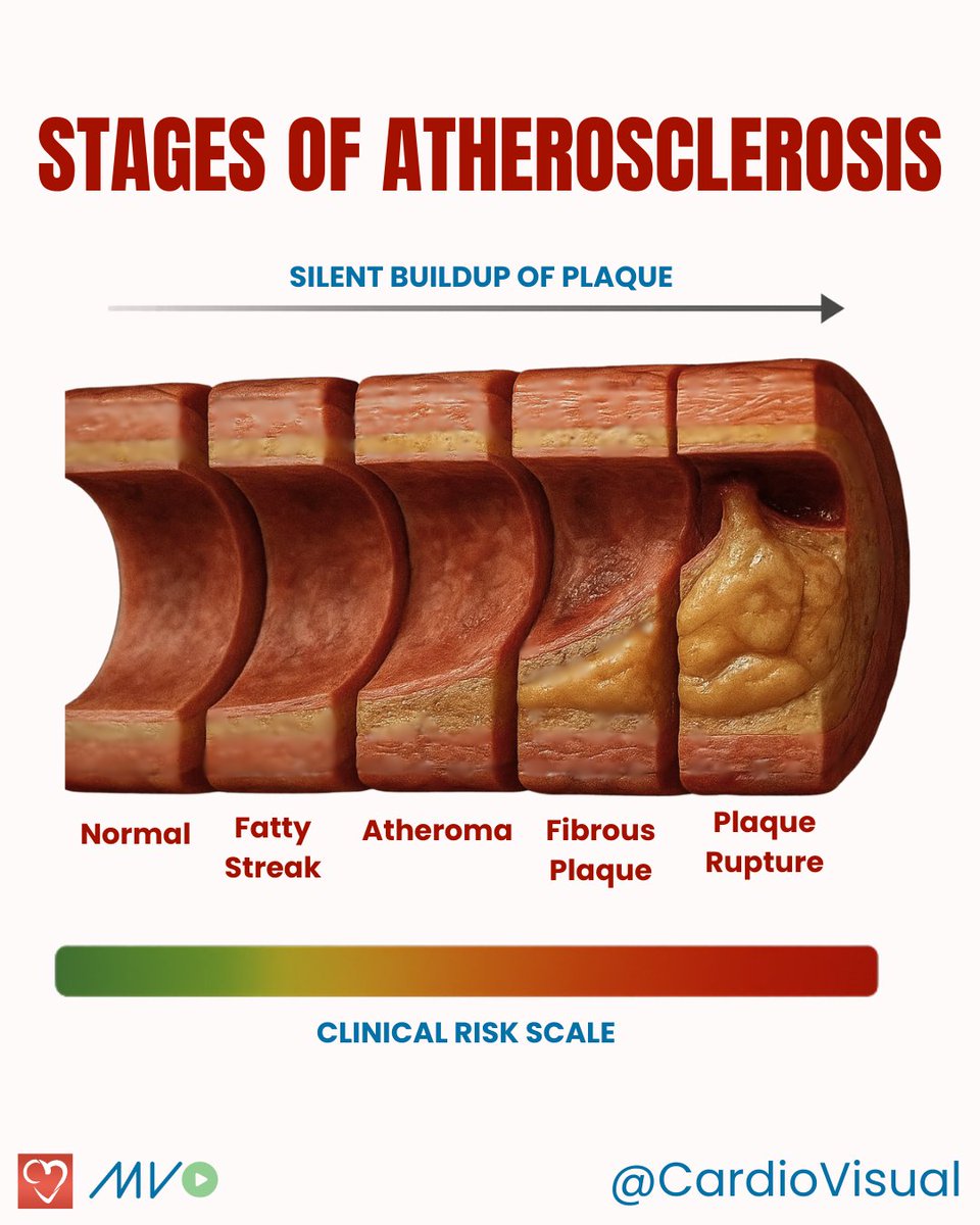 CardioVisualApp's tweet image. 🫀 Atherosclerosis is the buildup of plaque in the arteries, and it can progress silently for years before leading to serious events like heart attacks or strokes.
Follow Cardiovisual for simplified, visual medical education.
#HeartHealth #LpA #Atherosclerosis