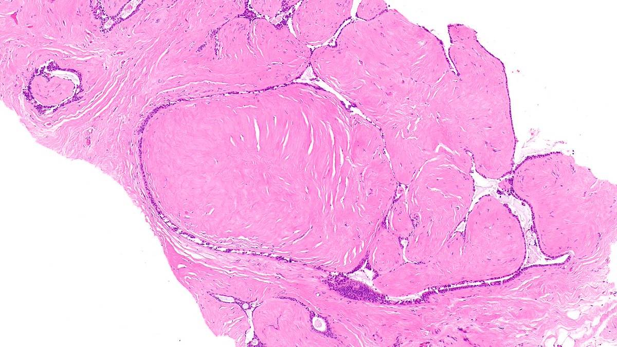 Let’s review various adenomas of breast this week!

Case of Fibroadenoma 🔬

Fibroadenoma—the most common tumor in young women—is a benign biphasic tumor composed of epithelial and specialized stromal elements of the terminal duct lobular unit.

#PathX #PathTwitter #breastpath