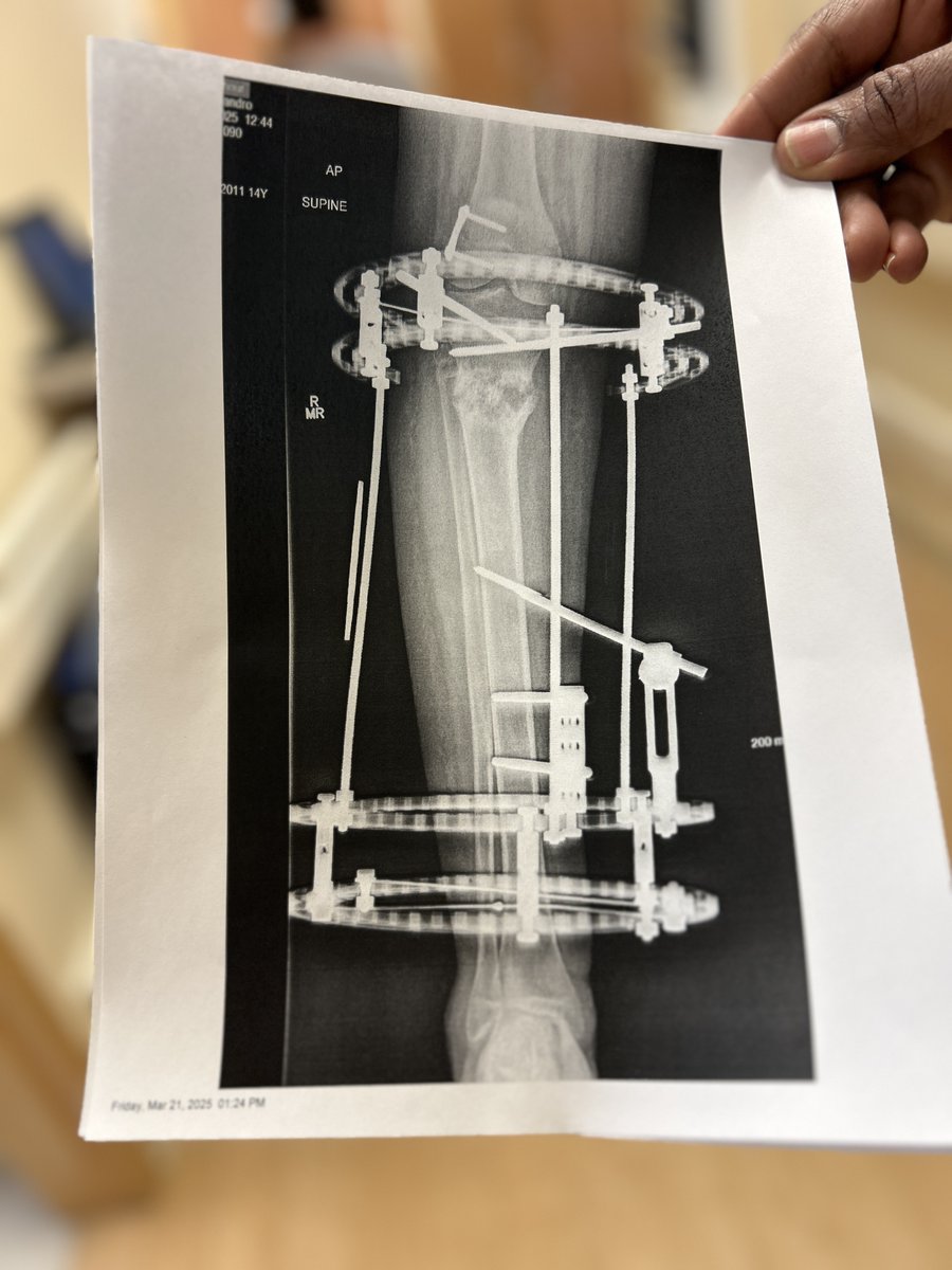 ShrinersStLouis's tweet image. Every child deserves to be part of their care. 💬
J. Eric Gordon, M.D., sits with Alejandro to go over his latest x-ray, making sure he understands his progress.
When kids are informed, they feel empowered. 💪🏻
Read more of Alejandro's patient story at: ow.ly/gfEH50W7liM