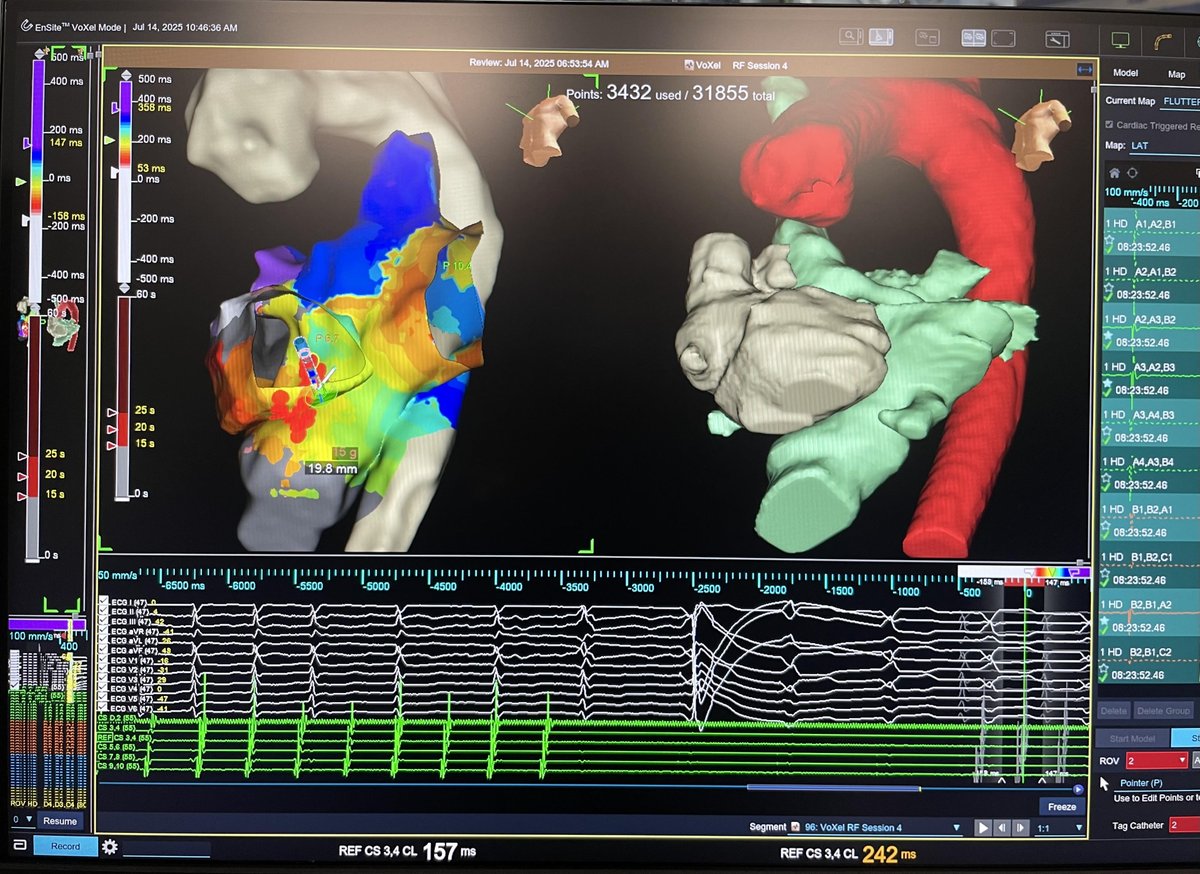 Dra_Jaurrigan's tweet photo. Another Happy Monday! Catheter #ablation of typical atrial #flutter in a patient post-#Mustard operation for #dTGA. CTI block achieved from both systemic (retroaortic approach) and pulmonary sides of the baffle. Zero fluoro procedure!😃 #EPeeps
@caruben89
@salud_aragon https://t.co/KpiXtDlymJ