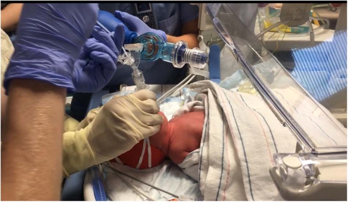NICU_Musings's tweet image. Quality improvement project using less invasive surfactant administration (LISA) for GA 25 - 31+6 wks in the delivery room led to:
⬇️DR intubations (65.5 to 52.6%)
⬆️Never requiring intubation (22.8 to 38%)
⬇️Grade 2 or 3 BPD (12.9 to 8.8%)
pubmed.ncbi.nlm.nih.gov/40640548/
#neoTwitter