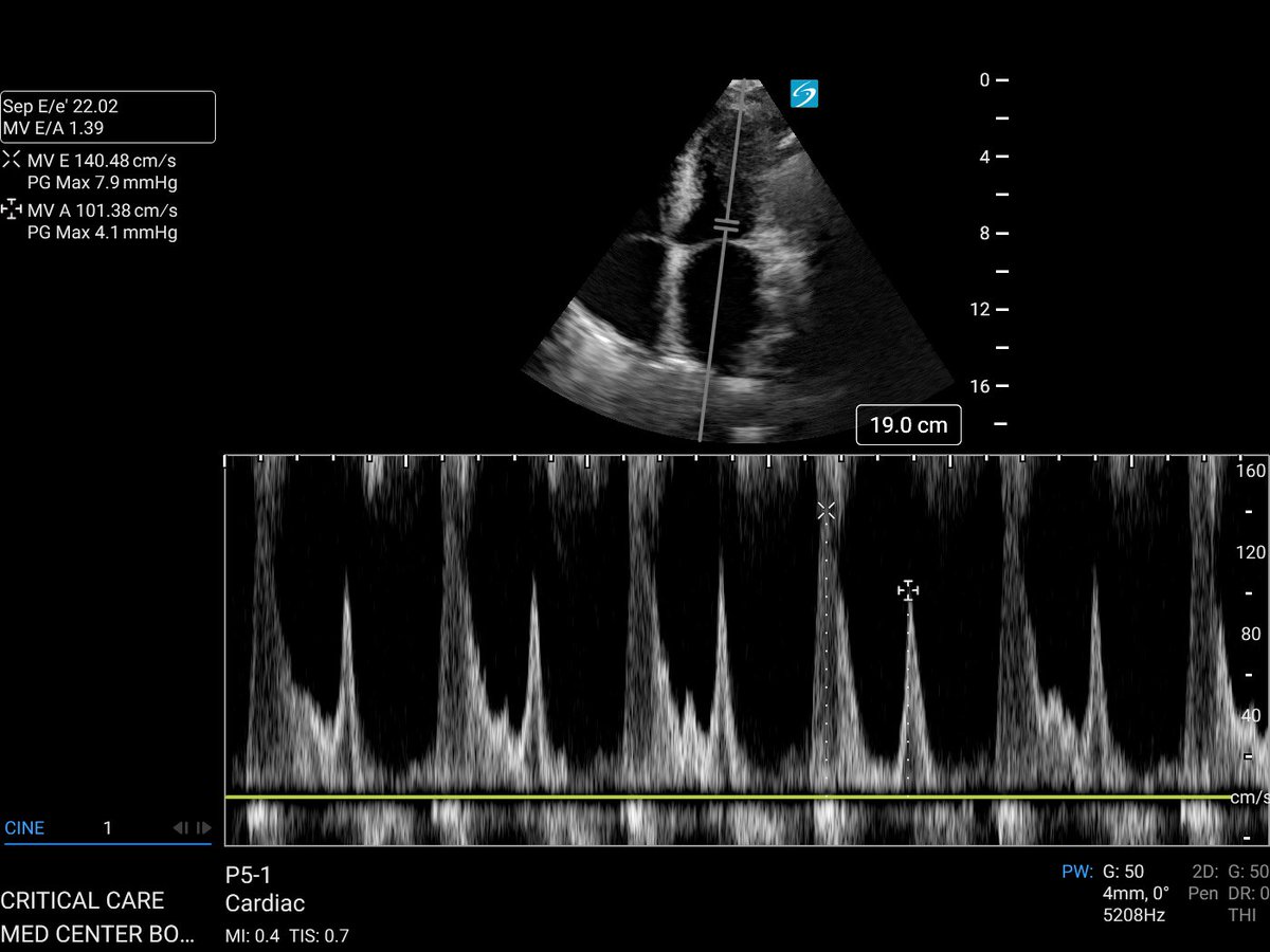 The L wave is an abnormal mid-diastolic flow wave seen on transmitral Doppler echocardiography, between the E and A waves. Again, suggestive of high LV filling pressure. Cumulatively, findings were consistent with Grade 3 diastolic dysfunction and VExUS grade 3. I have the