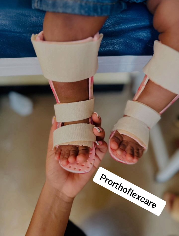 prostheticng's tweet photo. Custom-made AFO (Ankle-foot-orthosis) designed to enable mobility, enhance stability in a standing position, and provide support for individuals with gait / mobility issues.

Who benefits from an AFO?
• Foot drop 
• Ankle instability 
• Cerebral Palsy, etc

#footconditions https://t.co/W7qBNWoeXD