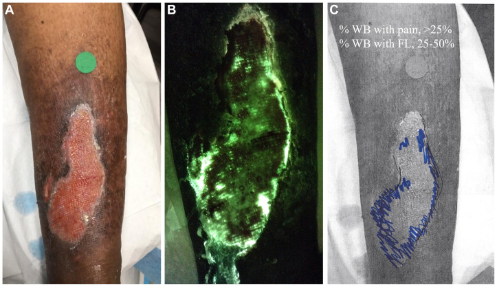 JVSVL's tweet image. Our July Issue is LIVE & that means so is the #CME article! "Unveiling the relationship between pain & bacterial load in venous ulcers with implications in targeted treatment". Check it out, let us know what you think, & don't forget to claim your CME!
jvsvenous.org/article/S2213-…
