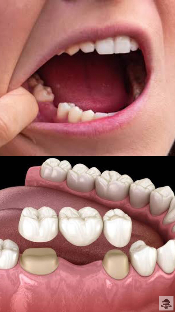 BaseBDG's tweet image. Punten euy, apakah ada yang gigi gerahamnya bolong dan mau dibikinin gigi tiruan jembatan sama koas dokter gigi? syarat nya usia min 25 tahun dan kooperatif selama perawatan di rsgm yang mau reply yaah