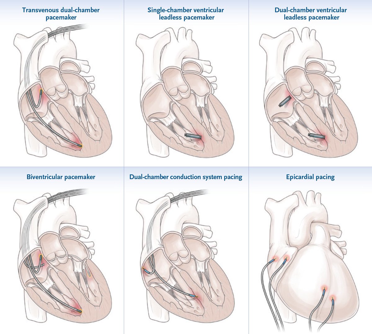 Pacemakers are critical in the management of bradyarrhythmias. 🫀 Aldaas and colleagues review pacemaker fundamentals, indications, and device types, as well as the role of pacemakers in heart failure, emerging advancements, and current limitations. eviden.cc/4ee15iB