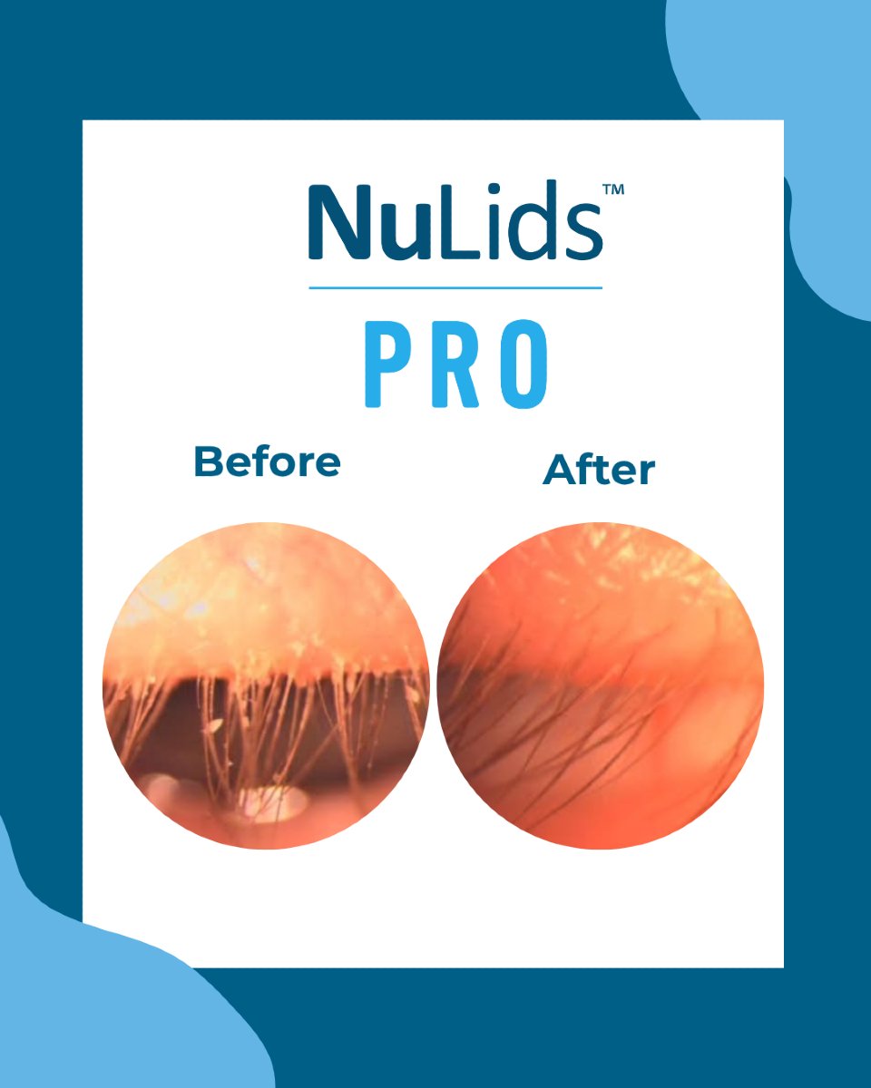 Psst... 👀 Your lashes need a cleaning. Check out what NuLIDS PRO can do for your patients 👆

📸 @city_of_vision