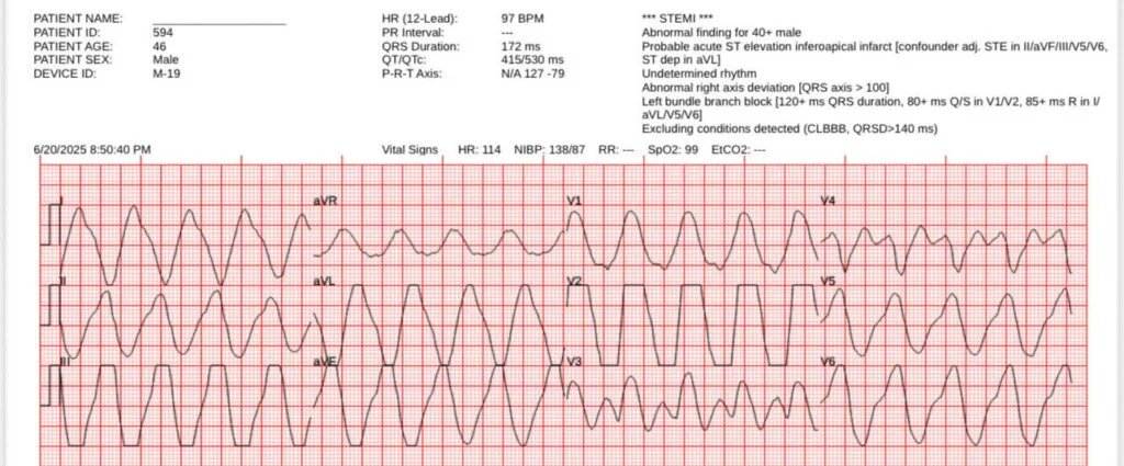 smithECGBlog's tweet image. Chest pain and nausea with a diagnostic ECG
drsmithsecgblog.com/chest-pain-and…
@PendellM