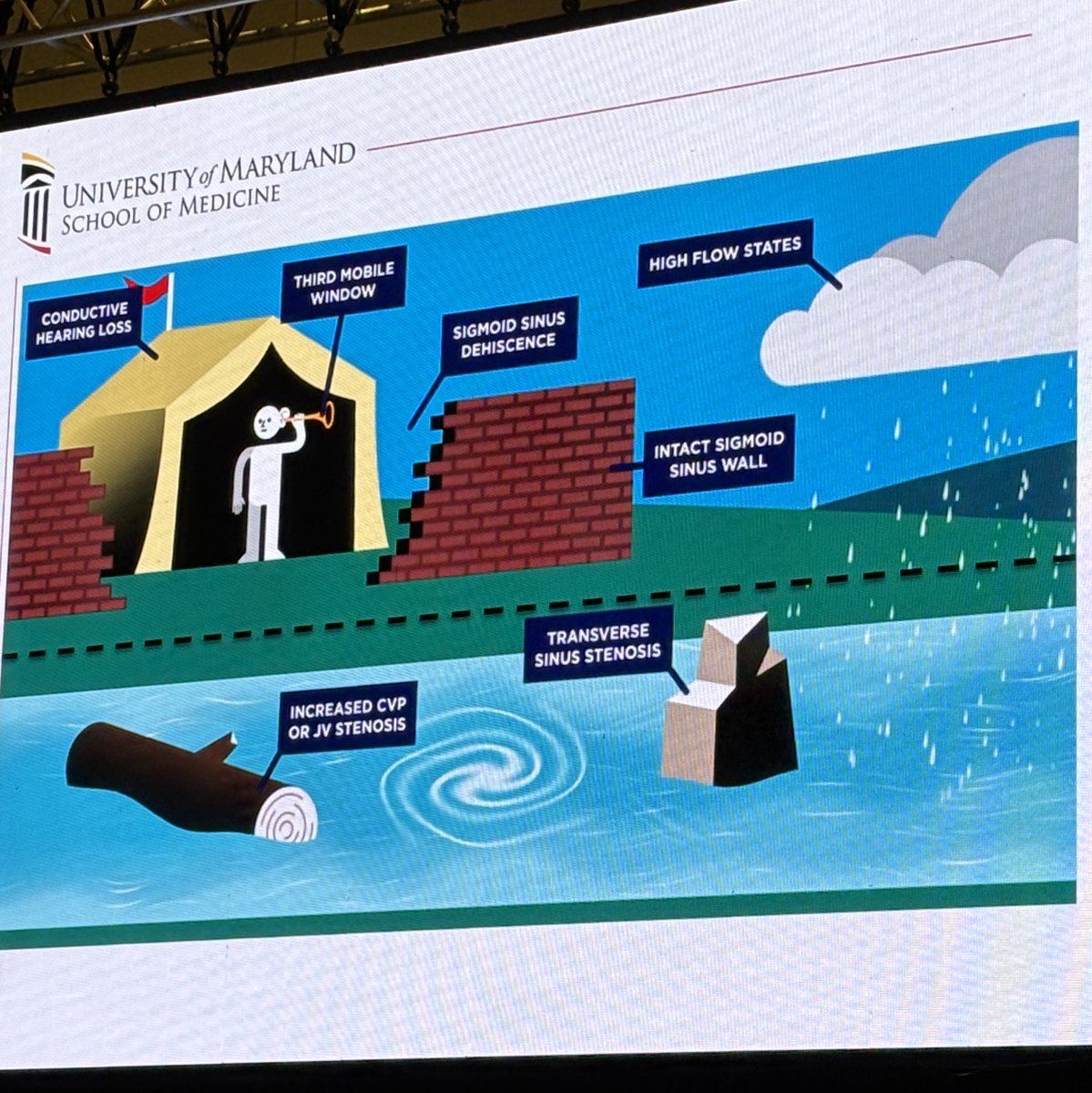 JNIS (@jnis_bmj) on Twitter photo <a href="/vitorpereiracan/">Vitor Mendes Pereira</a> speaking on his approach to the envascular approach to venous causes of pulsatile tinnitus. Dr. David Eisenman explains the two factors necessary for PT to happen. #SNIS2025 @SNISInfo <a href="/esmintsociety/">ESMINT Society</a> <a href="/cvsection/">CV Section</a> <a href="/fcalbuquerque51/">Felipe C. Albuquerque</a> <a href="/dr_mchen/">Michael Chen, MD</a> <a href="/DanniDiestro/">Dr. DiestroKE</a> <a href="/MattAmansMD/">Matthew Amans</a> <a href="/vitorpereiracan/">Vitor Mendes Pereira</a> speaking on his approach to the envascular approach to venous causes of pulsatile tinnitus. Dr. David Eisenman explains the two factors necessary for PT to happen. #SNIS2025 @SNISInfo <a href="/esmintsociety/">ESMINT Society</a> <a href="/cvsection/">CV Section</a> <a href="/fcalbuquerque51/">Felipe C. Albuquerque</a> <a href="/dr_mchen/">Michael Chen, MD</a> <a href="/DanniDiestro/">Dr. DiestroKE</a> <a href="/MattAmansMD/">Matthew Amans</a>