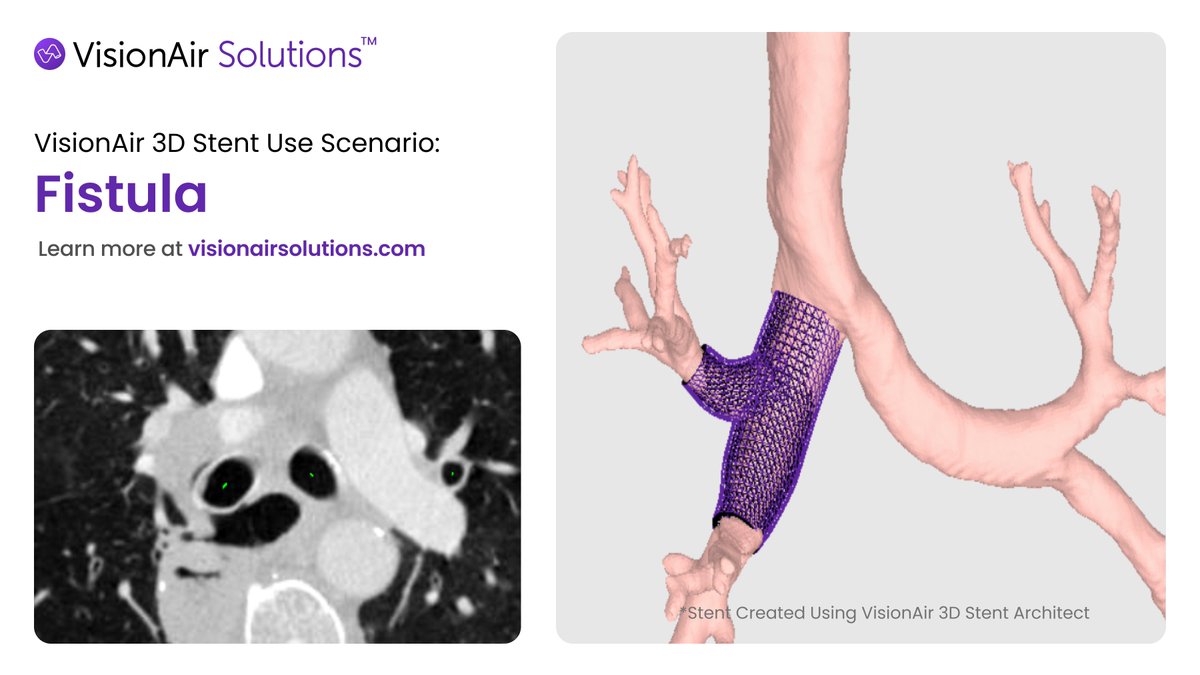 This #FistulaFriday we are displaying an airway that is malignant and has surgical anastomosis complications. With the right stent fit and contour within the airway, a fistula can be sealed.

💬 Let us know what you think!

#AirwayStenting #3DStent #PatientSpecific