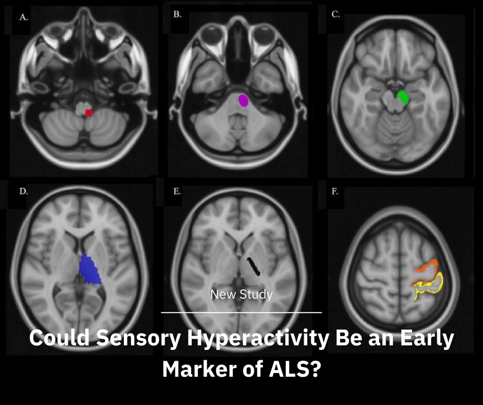 FixelInstitute's tweet image. The brain’s sensory system might be doing more in ALS than we thought—maybe even too much. 🧠⚡
New research is uncovering hidden changes that could reshape how we understand the disease.
🔗 Click the link to learn more: pmc.ncbi.nlm.nih.gov/articles/PMC12…