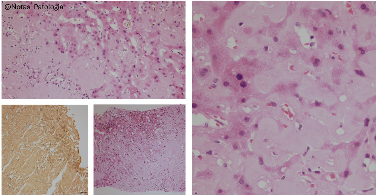🧬 Hepatic Amyloidosis: a rare and challenging diagnosis
Not every case of cholestatic jaundice with hepatomegaly is due to common liver diseases.

Although systemic amyloidosis is more frequently associated with renal and cardiac involvement, isolated hepatic amyloidosis is an