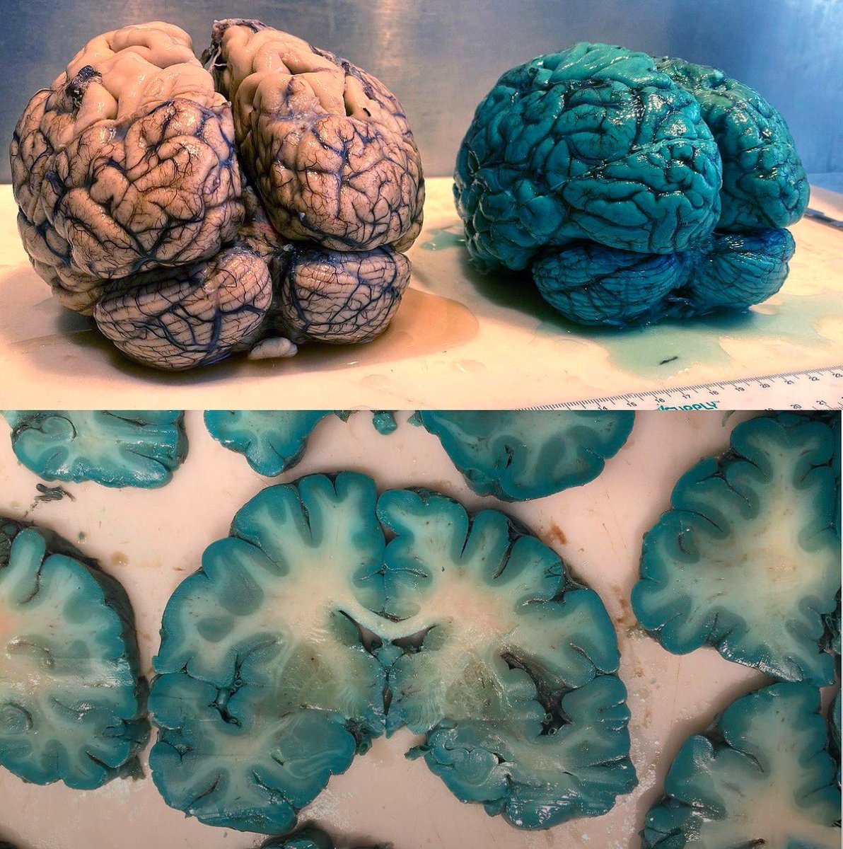 RobotPolisher's tweet image. A normal human brain and one treated with methylene blue before death