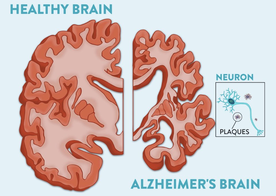 animaldocfilm's tweet image. Alzheimer's isn't genetic.

It's preventable, and might even be reversible.

And the solution starts with what's on your dinner plate.

The link between meat and Alzheimer's will shock you: 🧵