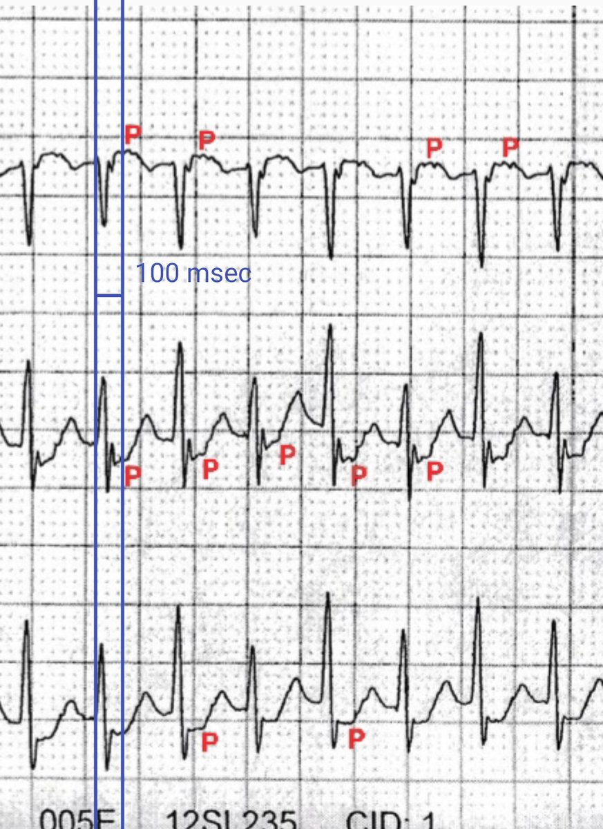 #ecg shows NCT with HR ~214bpm:

1. Lateral STD ~2mm in V5-V6 with STE aVR ~2mm suggests evidence of retrograde P wave activation
2. Pseudo r V1 &amp; Pseudo S II,III,aVF
3. Short RP⏭️ RP~100msec

🔺Short RP tachycardia - Orthodromic AVRT