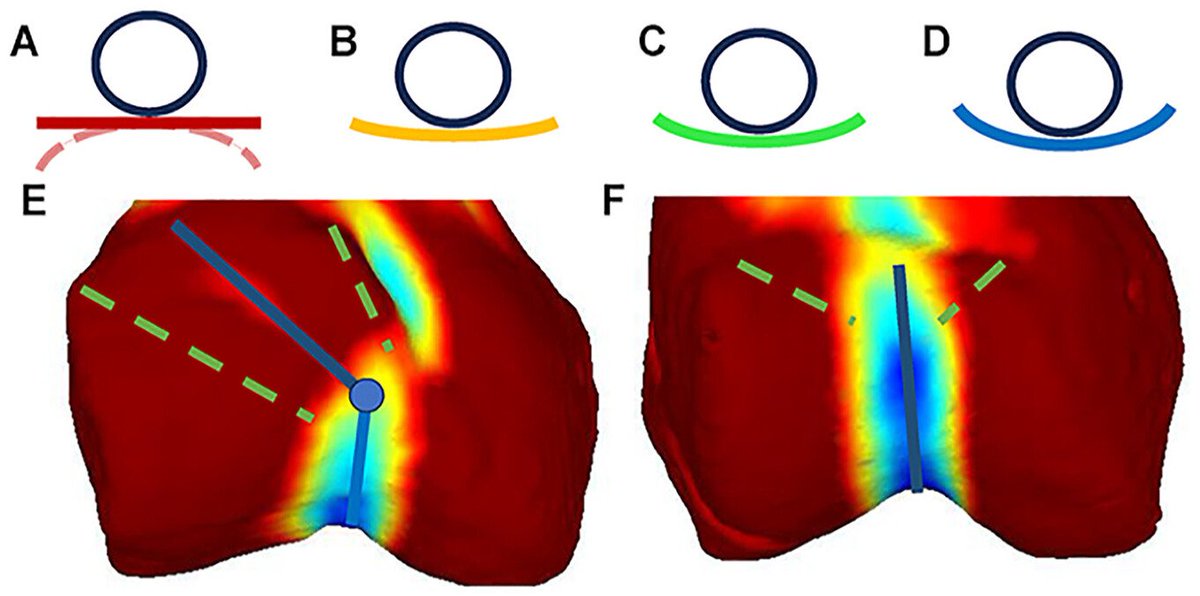armanafzadeh's tweet image. Our @Patelladoc group paper on entry point-transition point angle elevation in PFI patients, led by PhD student Johannes Sieberer and featuring his awesome Python/C# 3D curvature visualization tool (zenodo.org/records/112122…), is out now in @OJSM_SportsMed: doi.org/10.1177/232596…