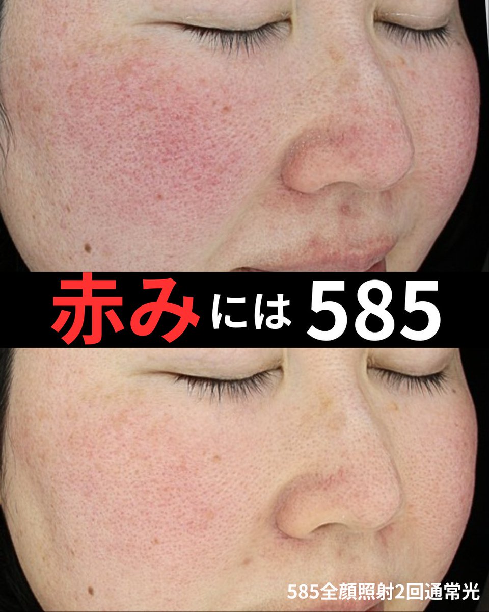 585を2回。良い!ダウンタイムがほとんど無いのも素晴らしい。赤み難民に朗報だ。