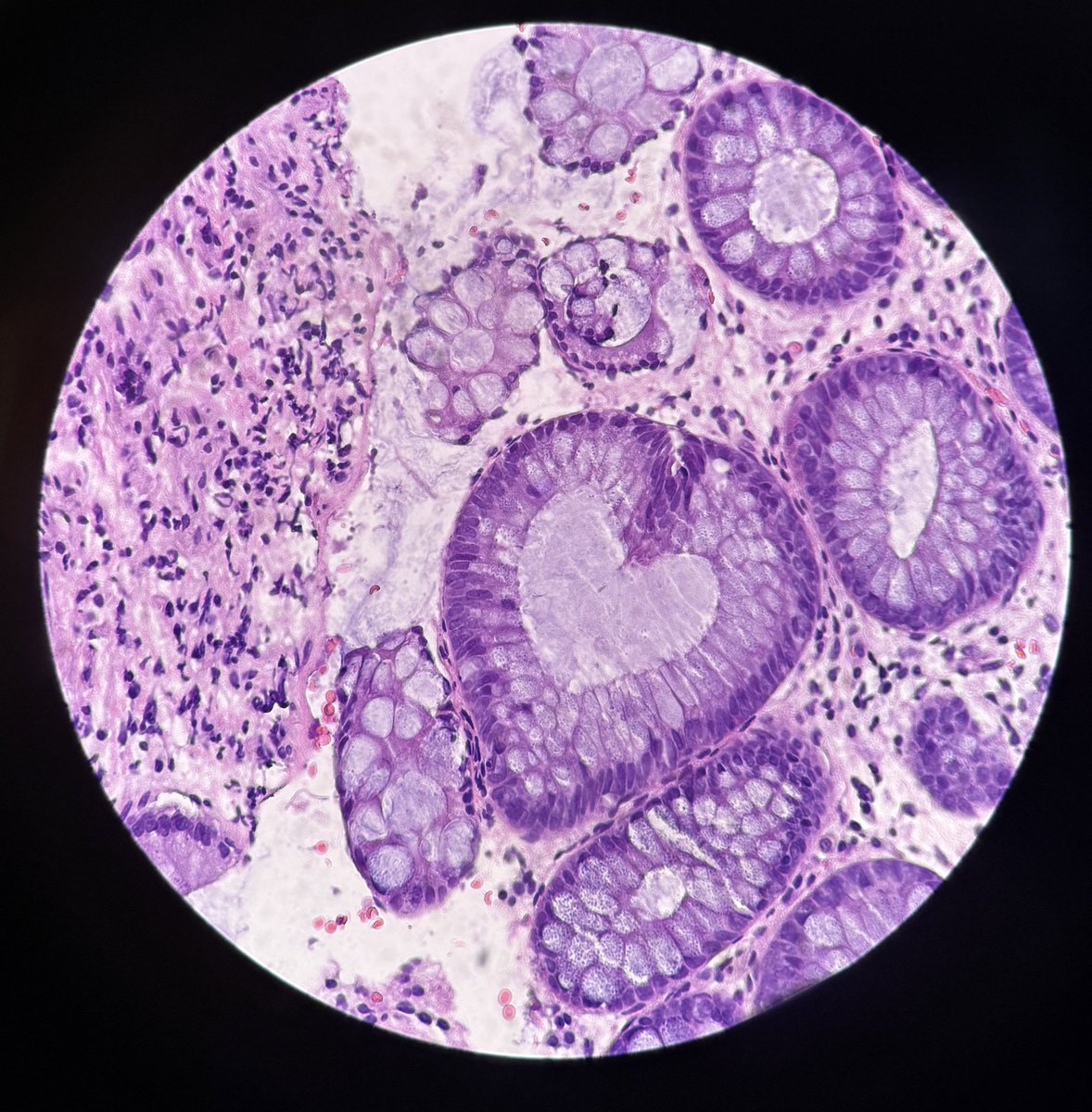 Return of the heart-shaped gland!! Week 11 of 12 weeks of surg path