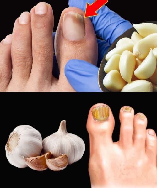 Got nail fungus?
Try this natural remedy straight from your kitchen!

Crush a garlic clove and apply it on the affected nail it antifungal allicin help to reduce yellowish and brittleness.

Affordable 
Easy to use 
Backed by tradition 

Sometime healing start with a clove.