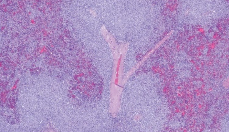 A global PETAL Consortium study found sequencing small molecule inhibitors followed by epigenetic modifiers significantly improves survival for #lymphoma patients. ow.ly/iqpN50Wo2qR