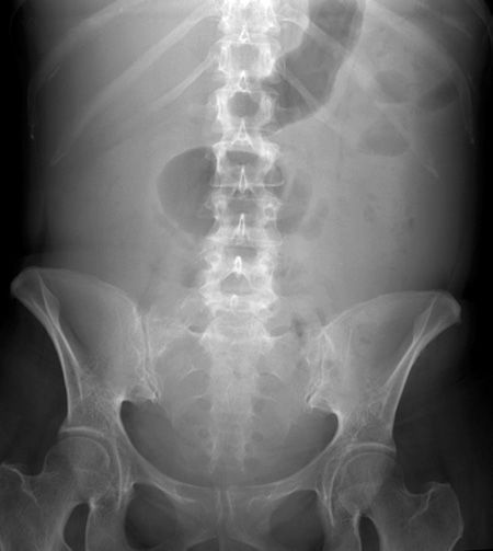 ABDOMINAL X-RAY 4: What is the abnormality and how do you explain the position of the bowel? Answer bit.ly/3WjIRUQ