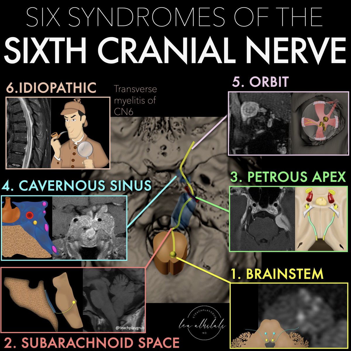 Wish you had a sixth sense to localize that sixth cranial nerve palsy?
 
Feeling six feet under when you see a sixth nerve deficit?
 
Here’s a how to locate the lesion in a sixth cranial nerve palsy!
 
Just remember the Six Syndromes of the Sixth Cranial Nerve!
 
One syndrome for