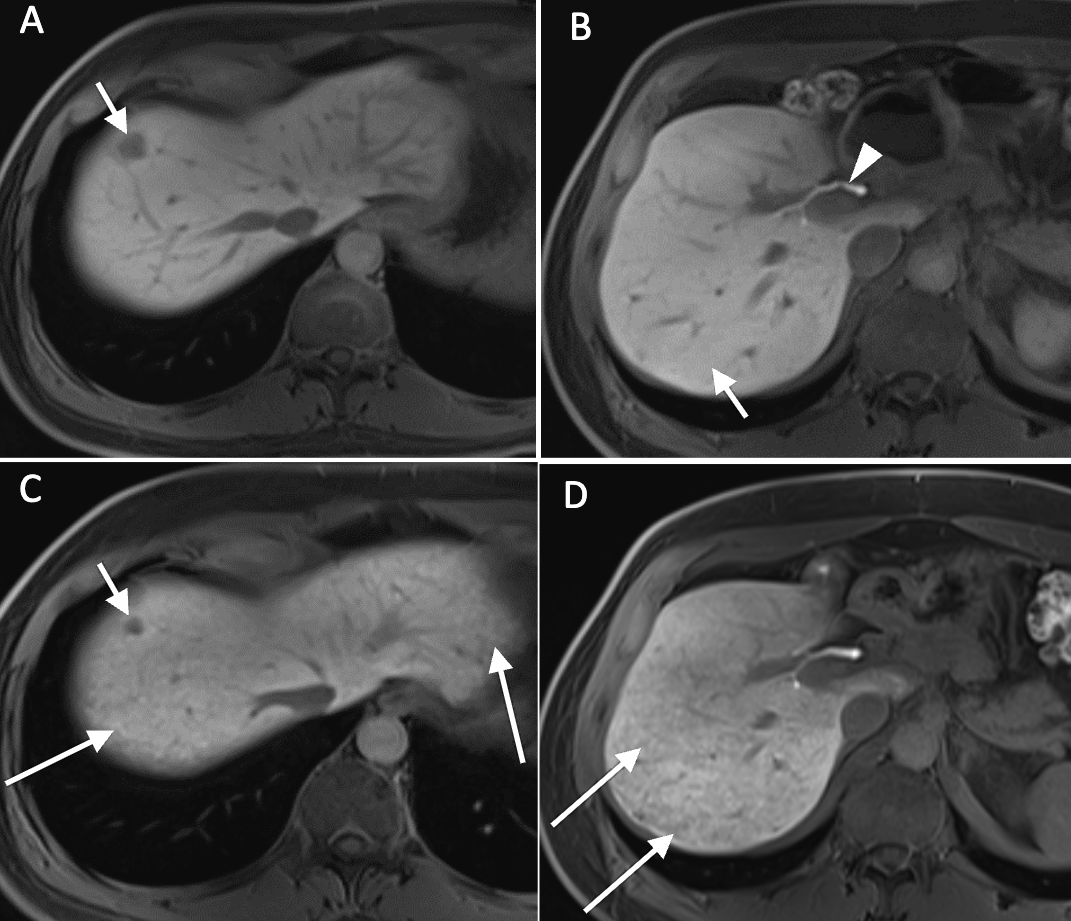 MedBlendPub's tweet image. #CaseOfTheDay
Sinusoidal Obstruction Syndrome in a 61M w/ colorectal liver mets treated w/ CAPOX
🩻 Pre-chemo: Homogeneous HBP uptake
🩻 Post-chemo: ↓Mets size but 👇
🔹 Inhomogeneous background and reticular hypointensity (C,D)
Seen w/ oxaliplatin-based Tx
#RadTwitter #radres