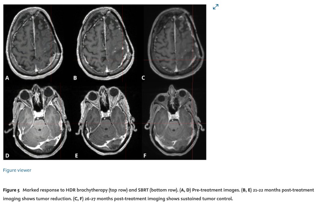Advances_ASTRO's tweet image. We've all experienced that relentless 🔁meningioma that keeps coming back!
In this teaching case👩🏫, a fourth recurrence of atypical meningioma was treated with HDR brachytherapy to 21 Gy in 1 fraction given challenges with re-RT (prior 20 Gy and 30 Gy 9 and 2 years prior,…