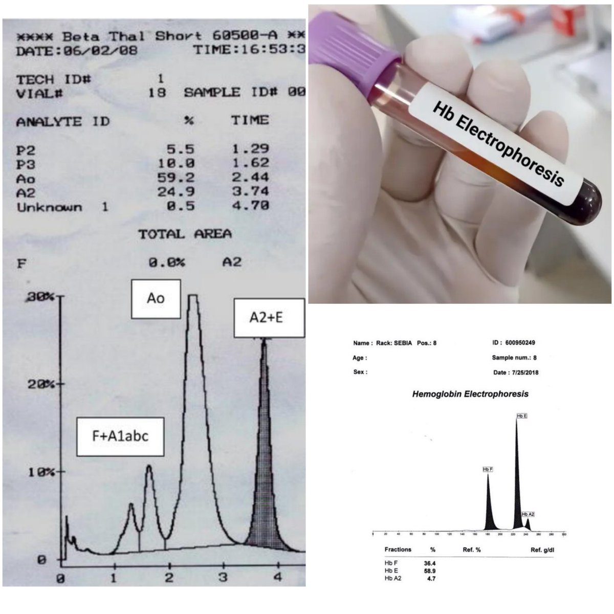 كيف يمكن لفحص "الهيموجلوبين الكهربي" (Hemoglobin Electrophoresis) أن يساعد في تشخيص أنواع  الأنيميا الوراثية مثل الثلاسيميا والأنيميا المنجلية؟ 🧬
#مختبرات_طبية