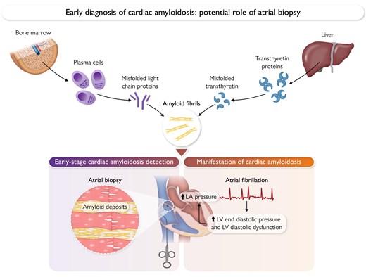 ehj_ed's tweet image. Which role for atrial biopsy in early-stage cardiac amyloidosis?
doi.org/10.1093/eurhea…
#biopsy #amyloidosis #cardiotwitter, @ESC_Journals, @escardio