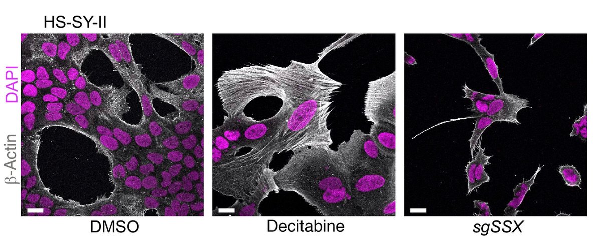 the_asci's tweet image. Finding success with demethylating drugs in preclinical models of a deadly malignancy—
ASCI member Kevin B. Jones & team @UUtah report on hypomethylation of CpG islands in synovial sarcoma and the use of decitabine and azacytidine in the inhibition of tumor growth:…
