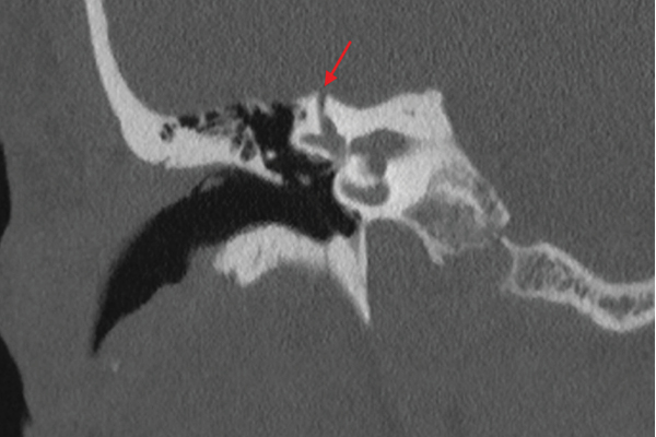Duke_Oto's tweet image. SSCD affects 1–2% of people, but few develop SCDS symptoms. At Duke Health, Dr. Eric J. Formeister leads expert diagnosis and care for SCDS, which causes vertigo, autophony, and more—often overlapping with vestibular migraine, complicating diagnosis.
duke.is/b/7g3e