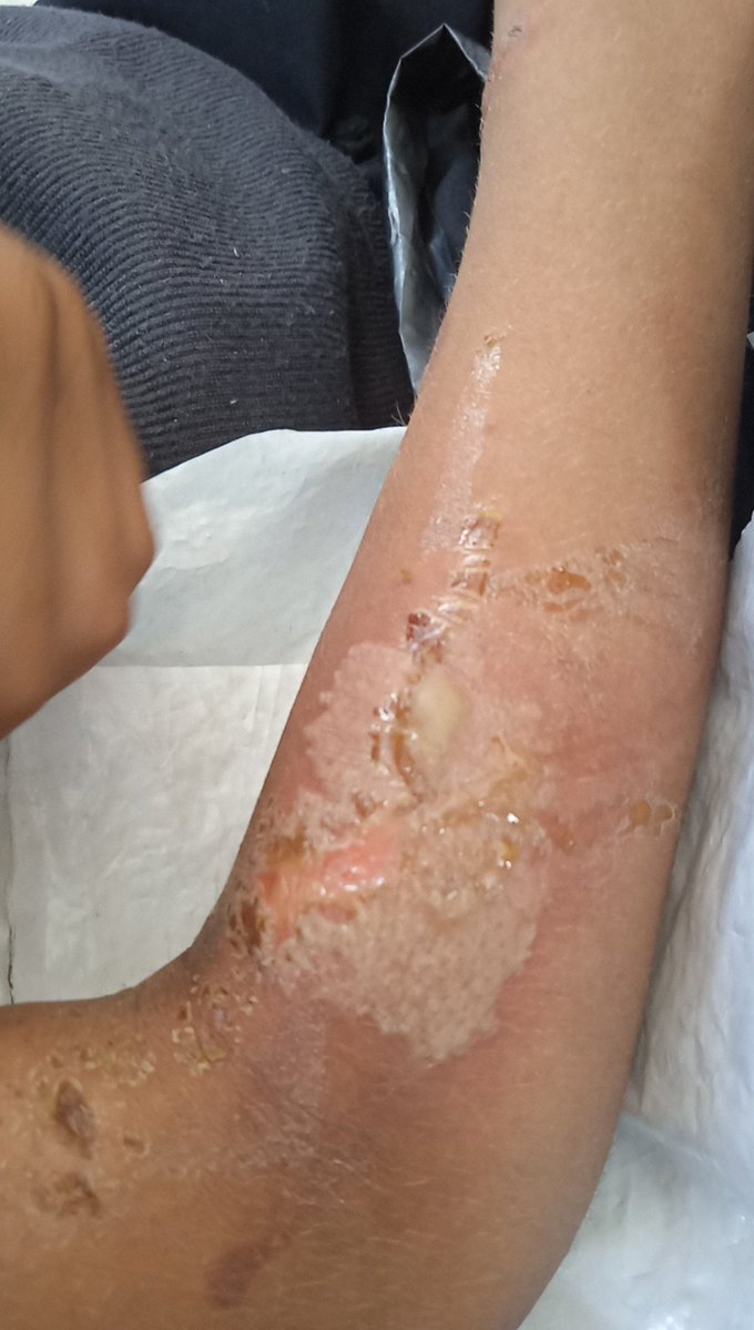 AsmBdwn37631's tweet image. We went to the doctor today. He told us that the burn is second degree and that we need a good ointment. $30 Please donate and share. #VerifiedByRadioWatermelon