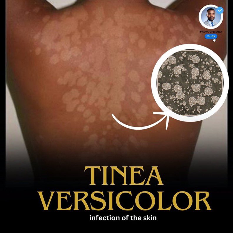 Wonder what these discolored patches on image below is?

It is Tinea Versicolor! 

Let me show what it is, how to treat it, and tips to keep your skin clear

A thread